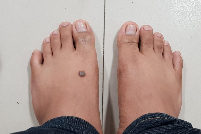 Warts on Feet
