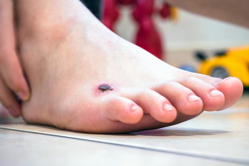 Warts