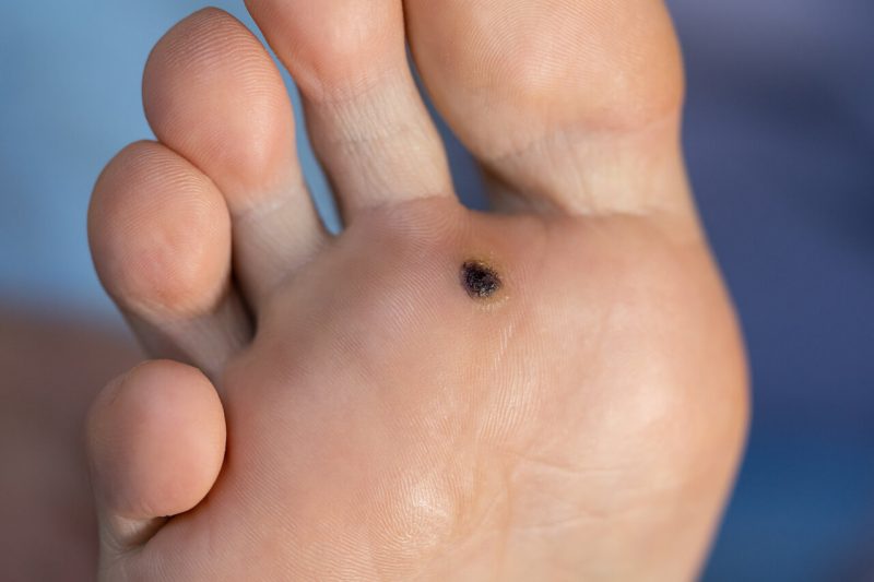 plantar wart