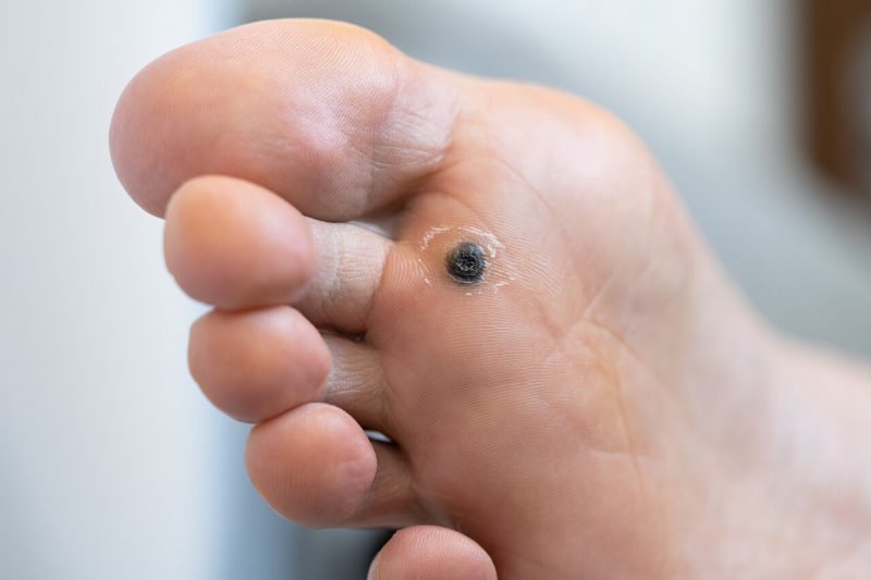 plantar wart
