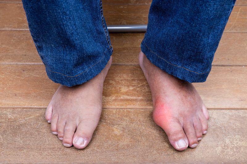 bunion