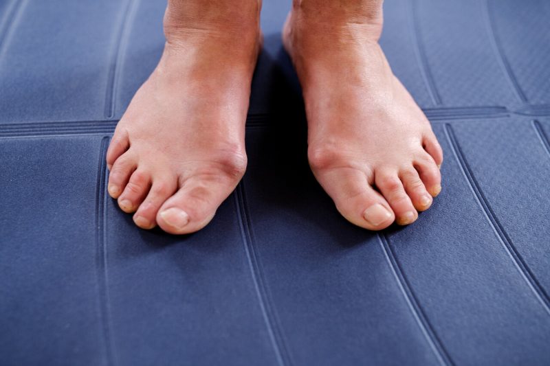 bunion