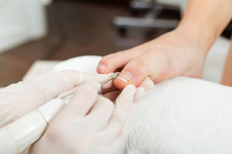 Ingrown Toenails