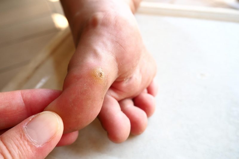Wart