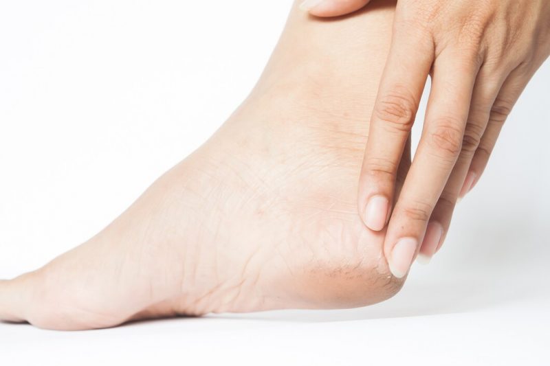 Plantar Wart